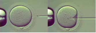 IVF
